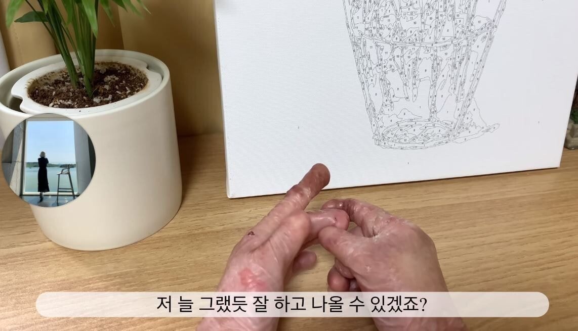 희귀 피부병 환자 유튜버의 브이로그 - 짤티비