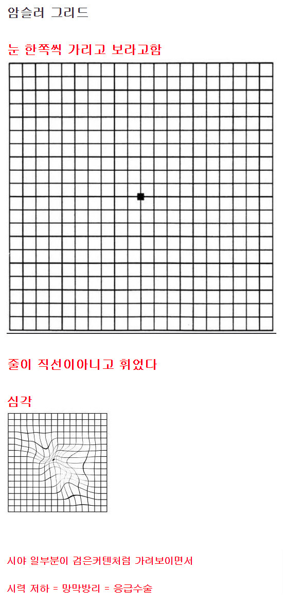 방치하면 실명할 수 있는 눈 이상 증상 - 짤티비