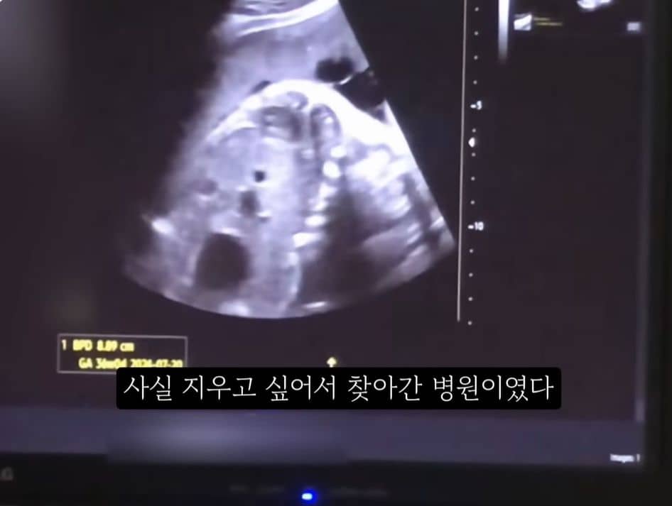 유튜버 꼼죽이 산부인과에서 초음파 검사를 받는 모습