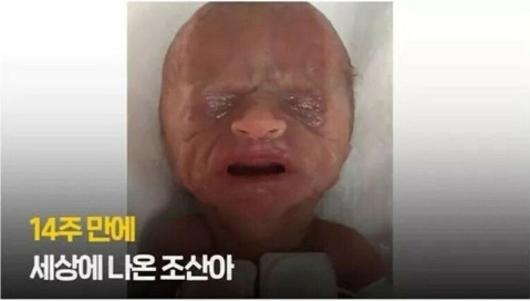 14주 만에 태어난 미숙아의 기적 - 꾸르