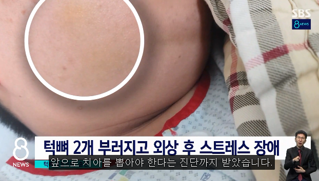 중학생 턱뼈 부러뜨린 태권도 관장…내놓은 해명 - 짤티비