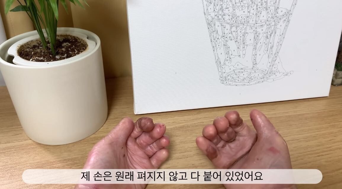 희귀 피부병 환자 유튜버의 브이로그 - 짤티비